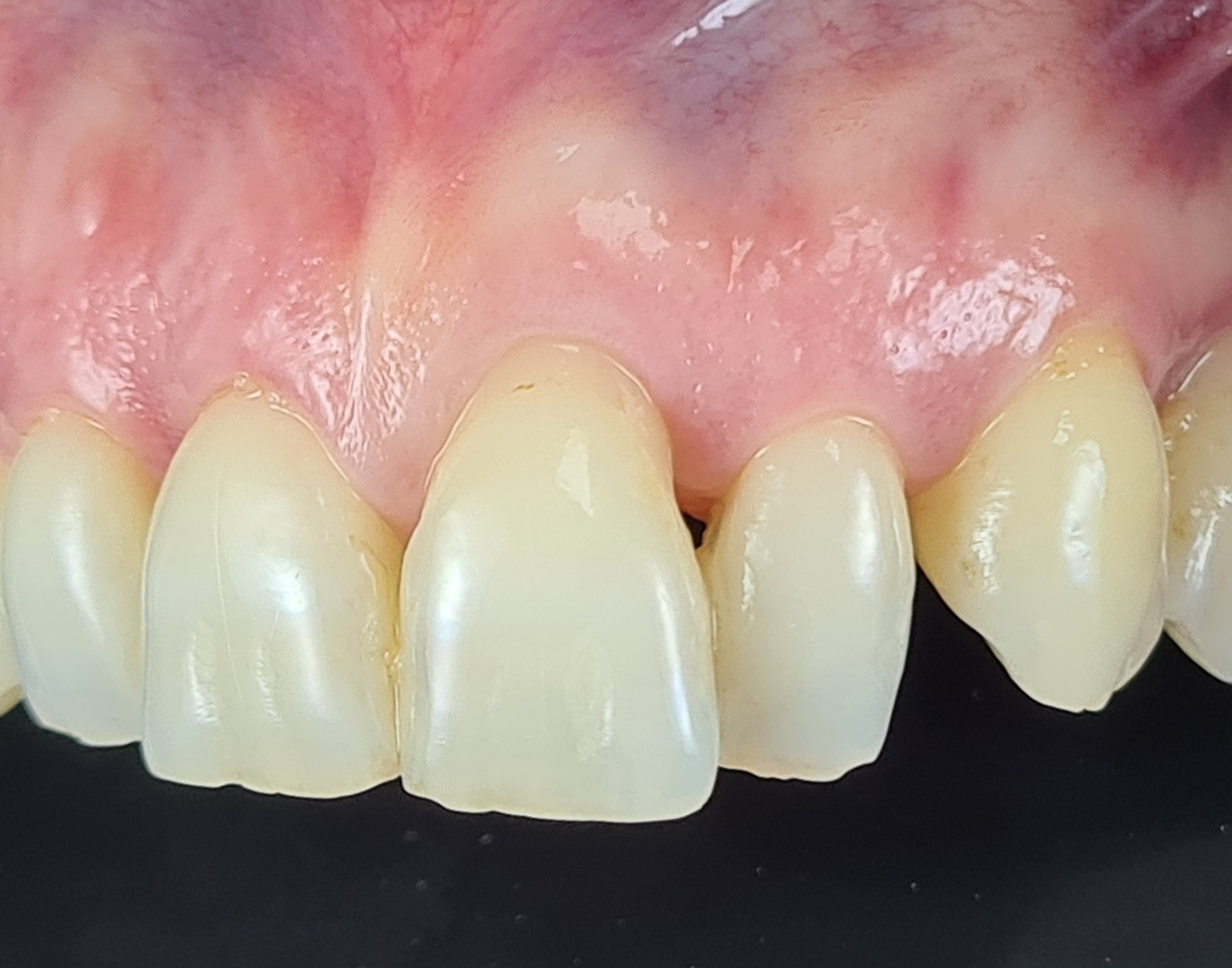 Before anterior gum rejuvenation treatment.