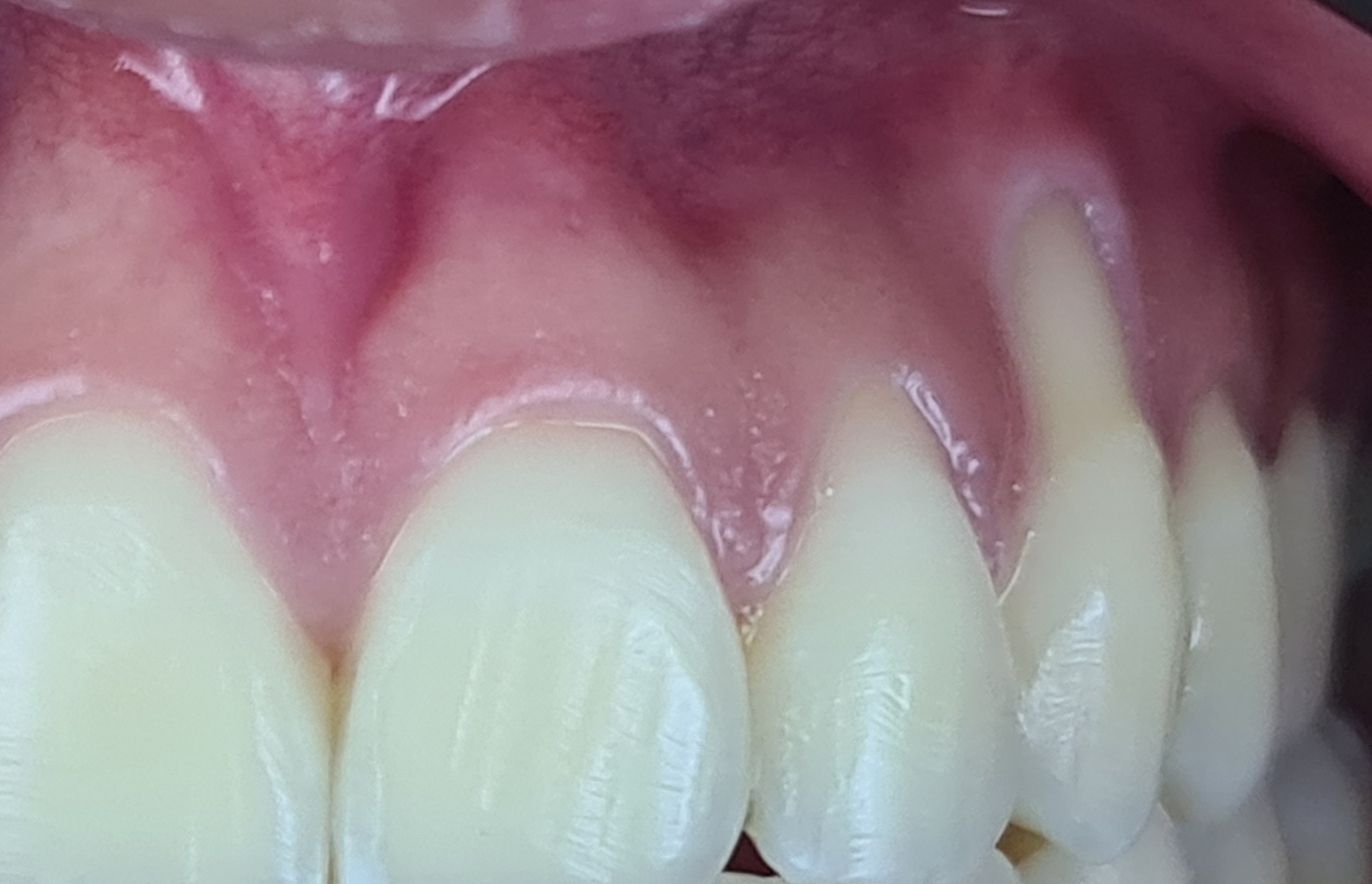 Before anterior gum rejuvenation treatment.