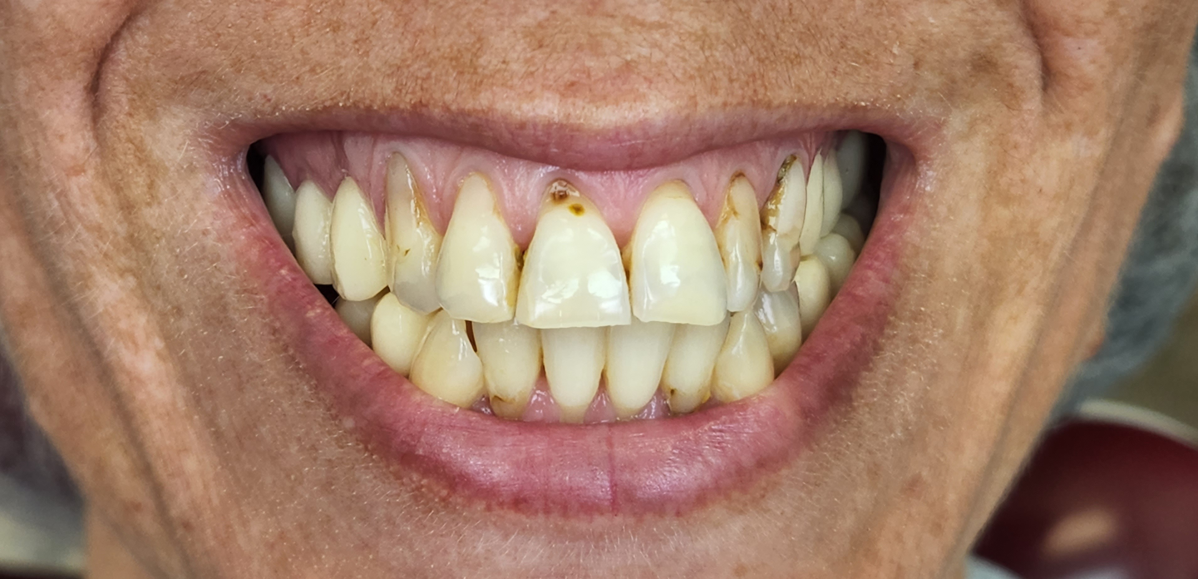 Before smile-level gum rejuvenation treatment.