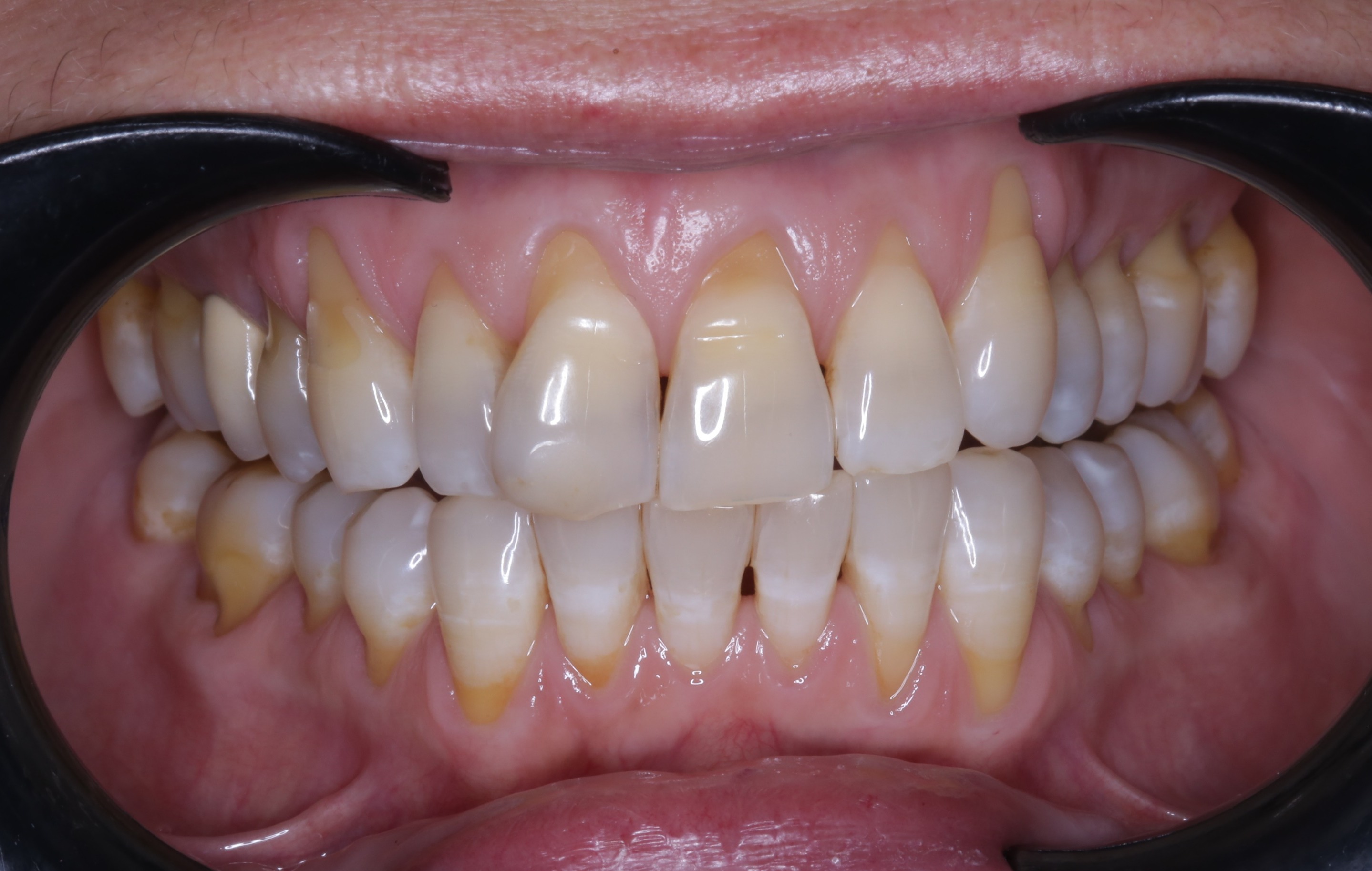 Before full-smile gum rejuvenation treatment.