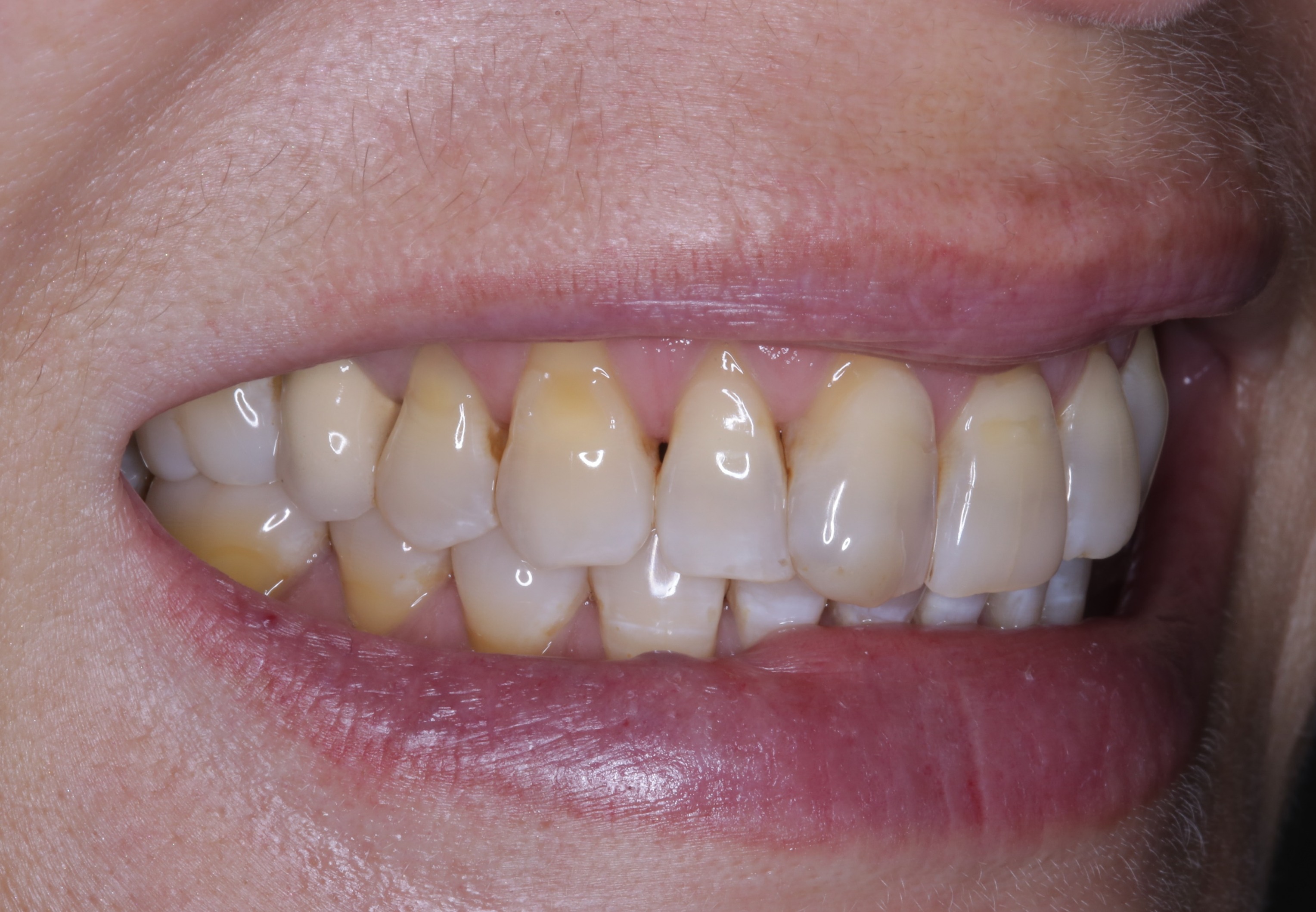 Before side-smile gum rejuvenation treatment.