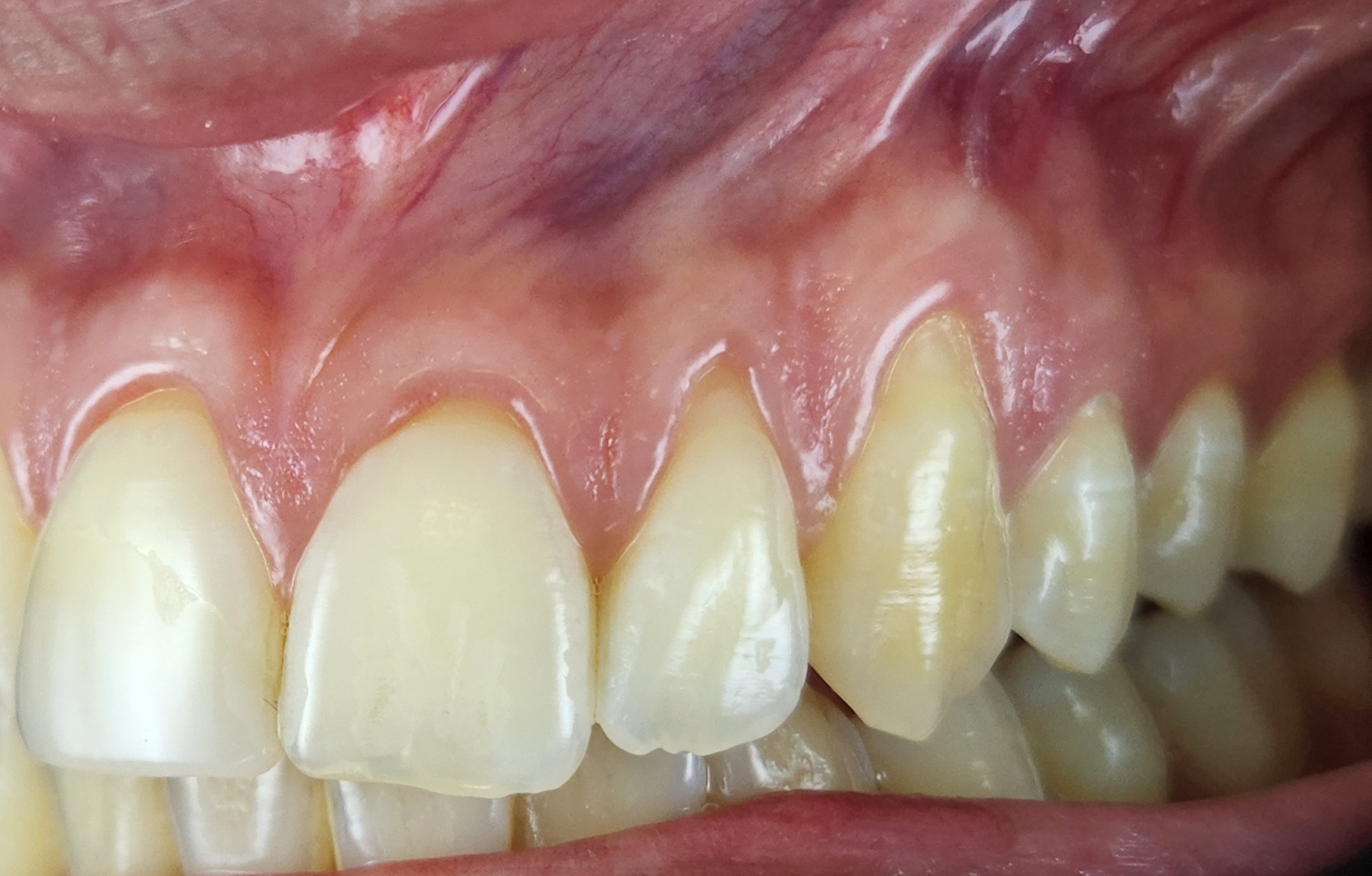 Before anterior-lateral gum rejuvenation treatment.