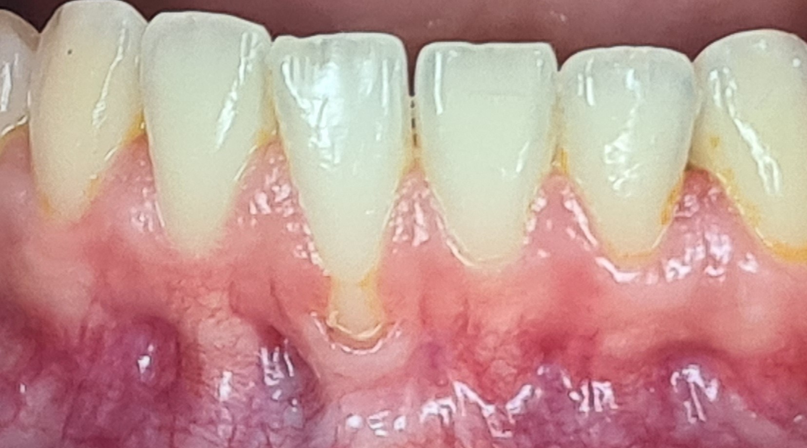 Before lower anterior gum rejuvenation treatment.