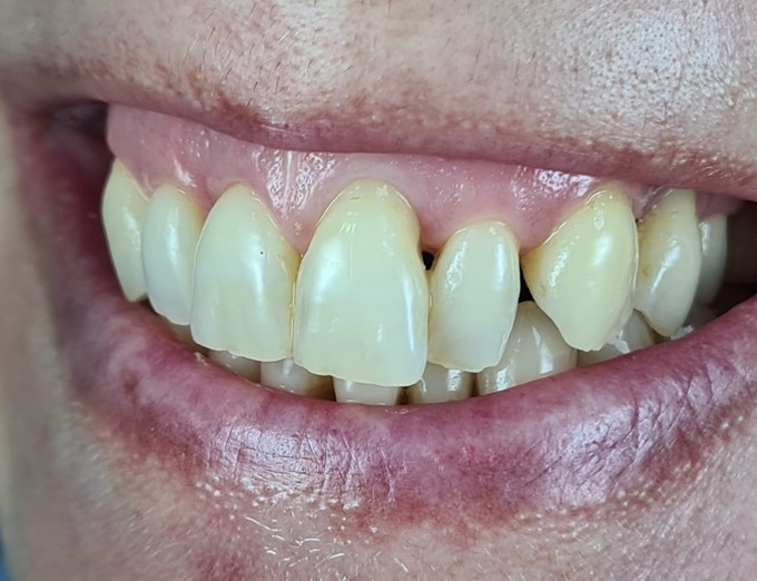 Before Miller Class III recession coverage treatment.