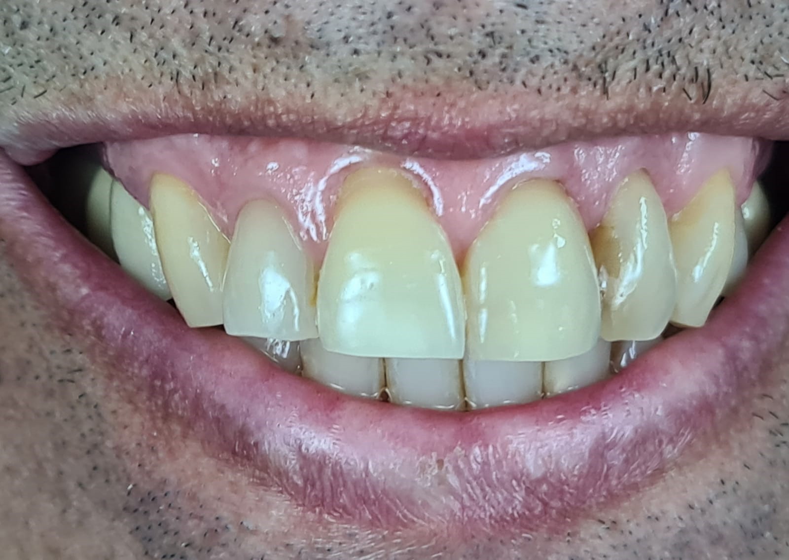 Before smile-level Miller Class III gum rejuvenation treatment.