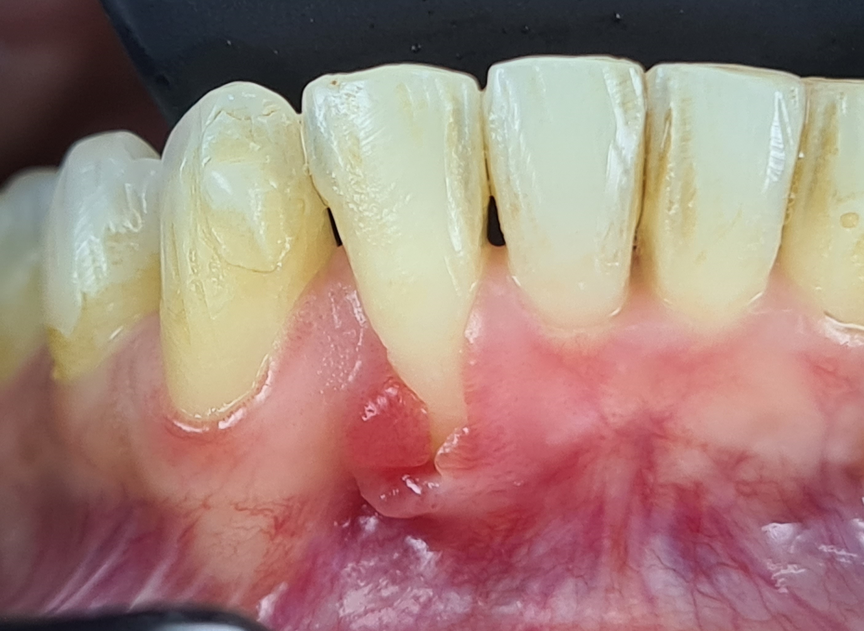 Before lower anterior recession coverage treatment.