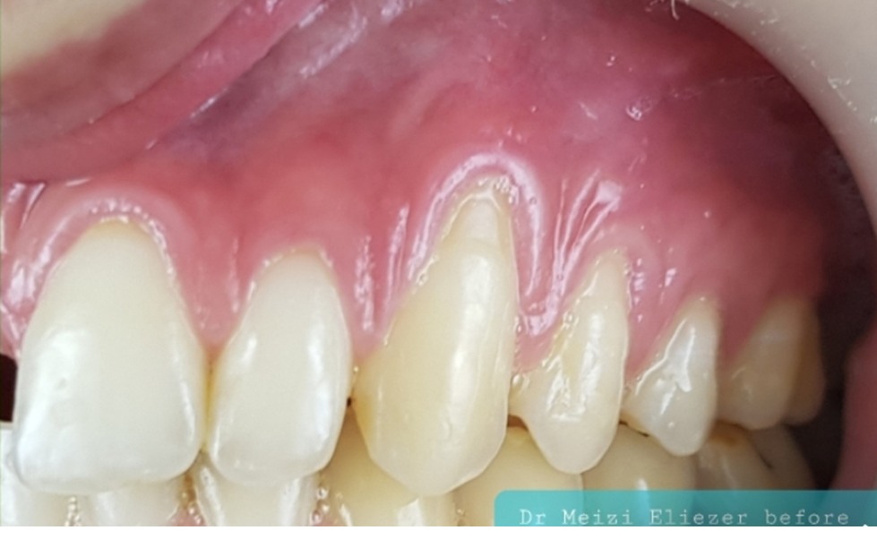 Before anterior-lateral gum rejuvenation treatment.