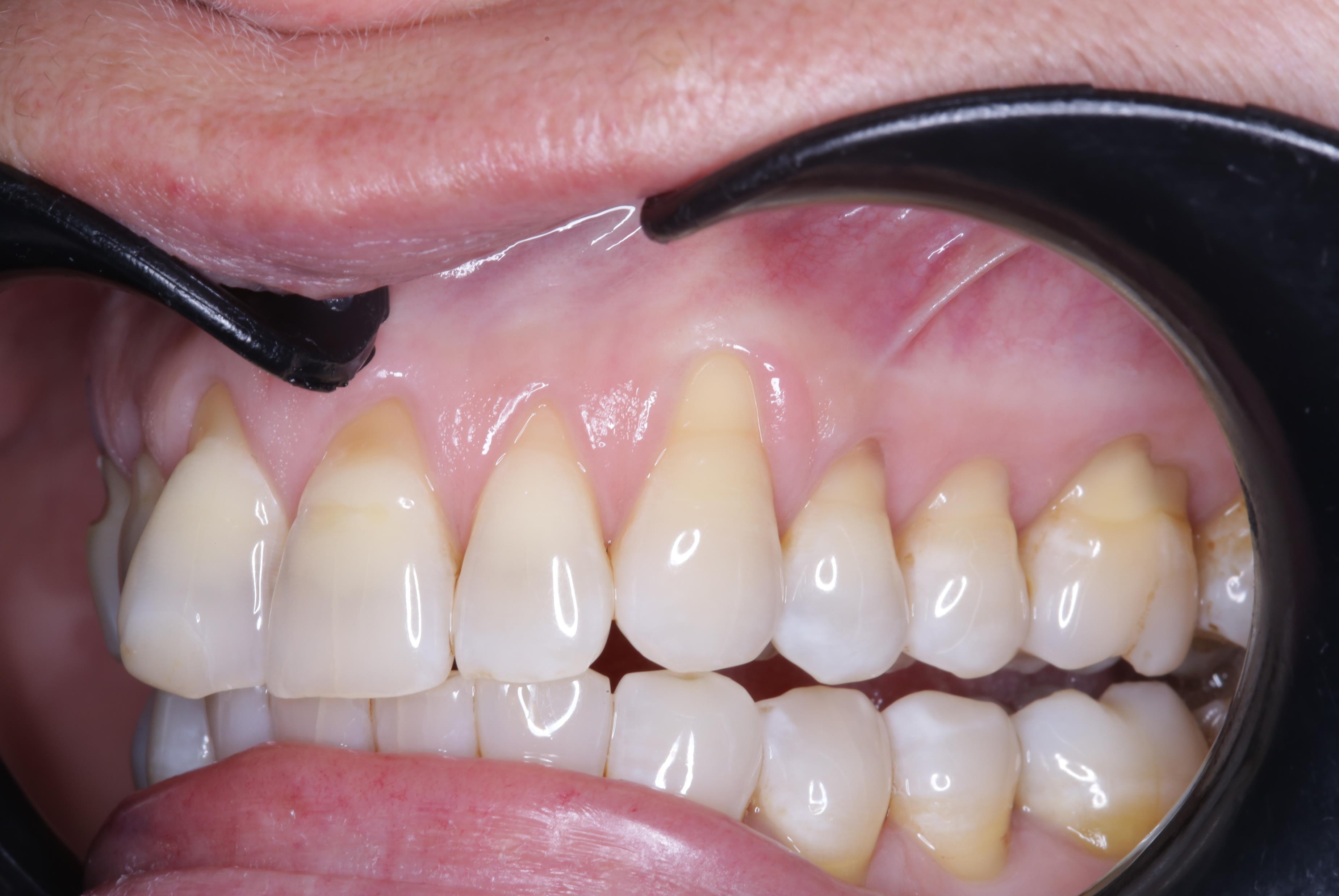 Before anterior-lateral gum rejuvenation treatment.