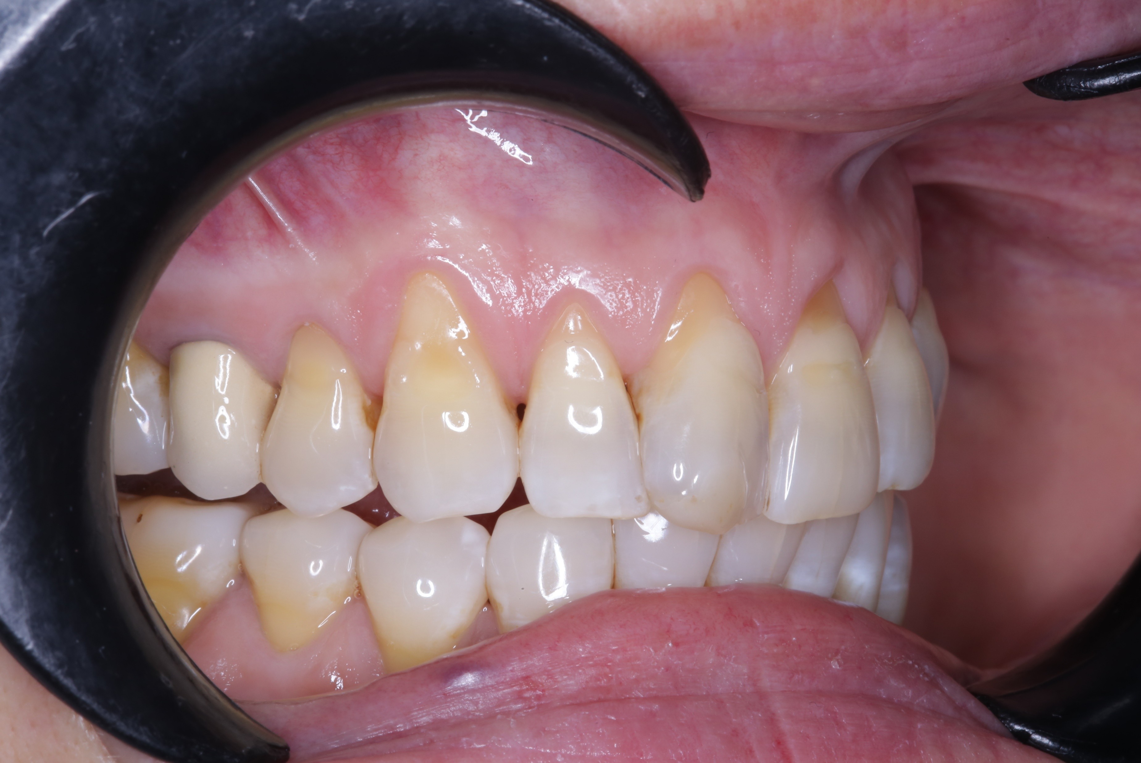 Before lateral gum rejuvenation treatment.