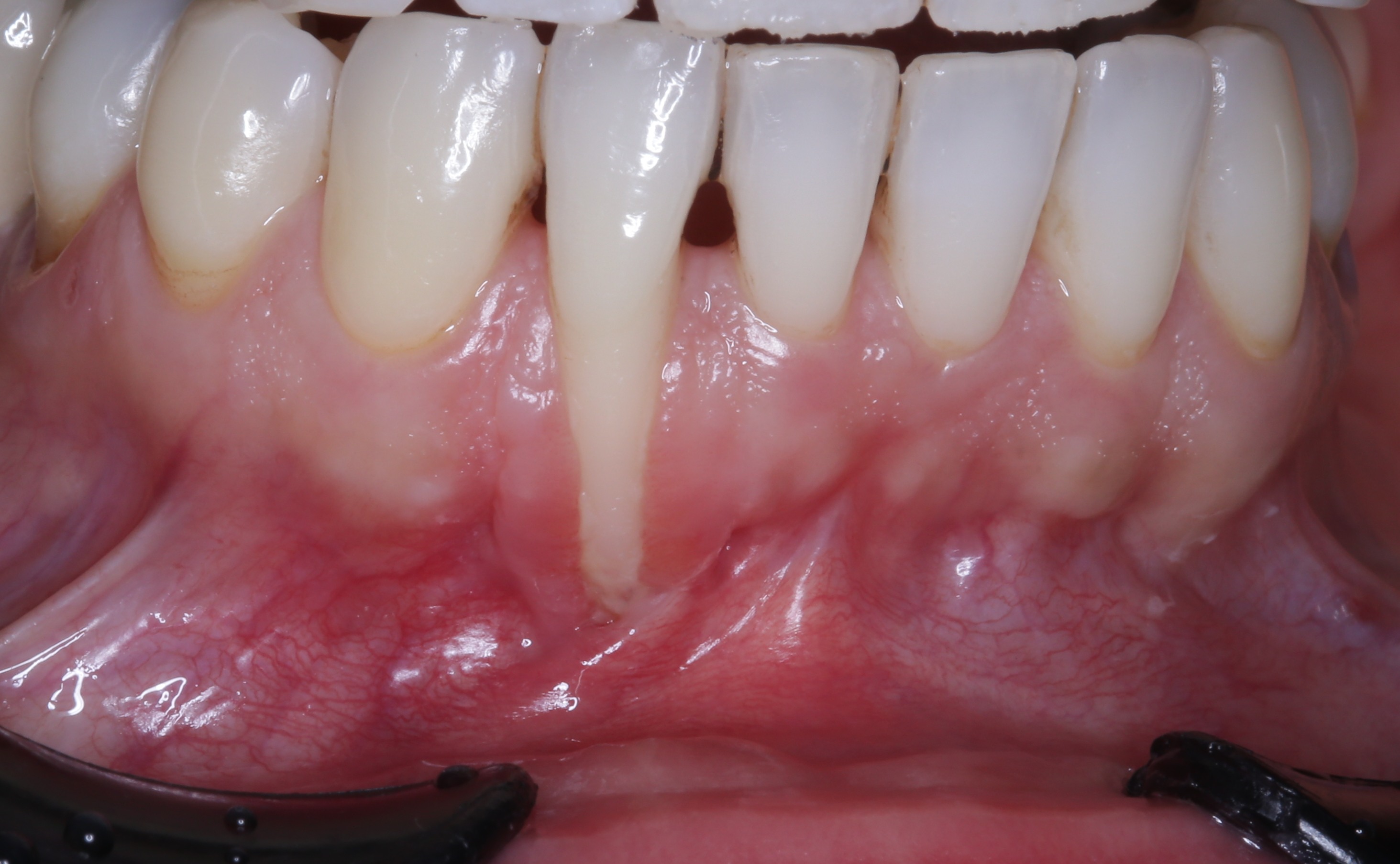 Before gum rejuvenation treatment.