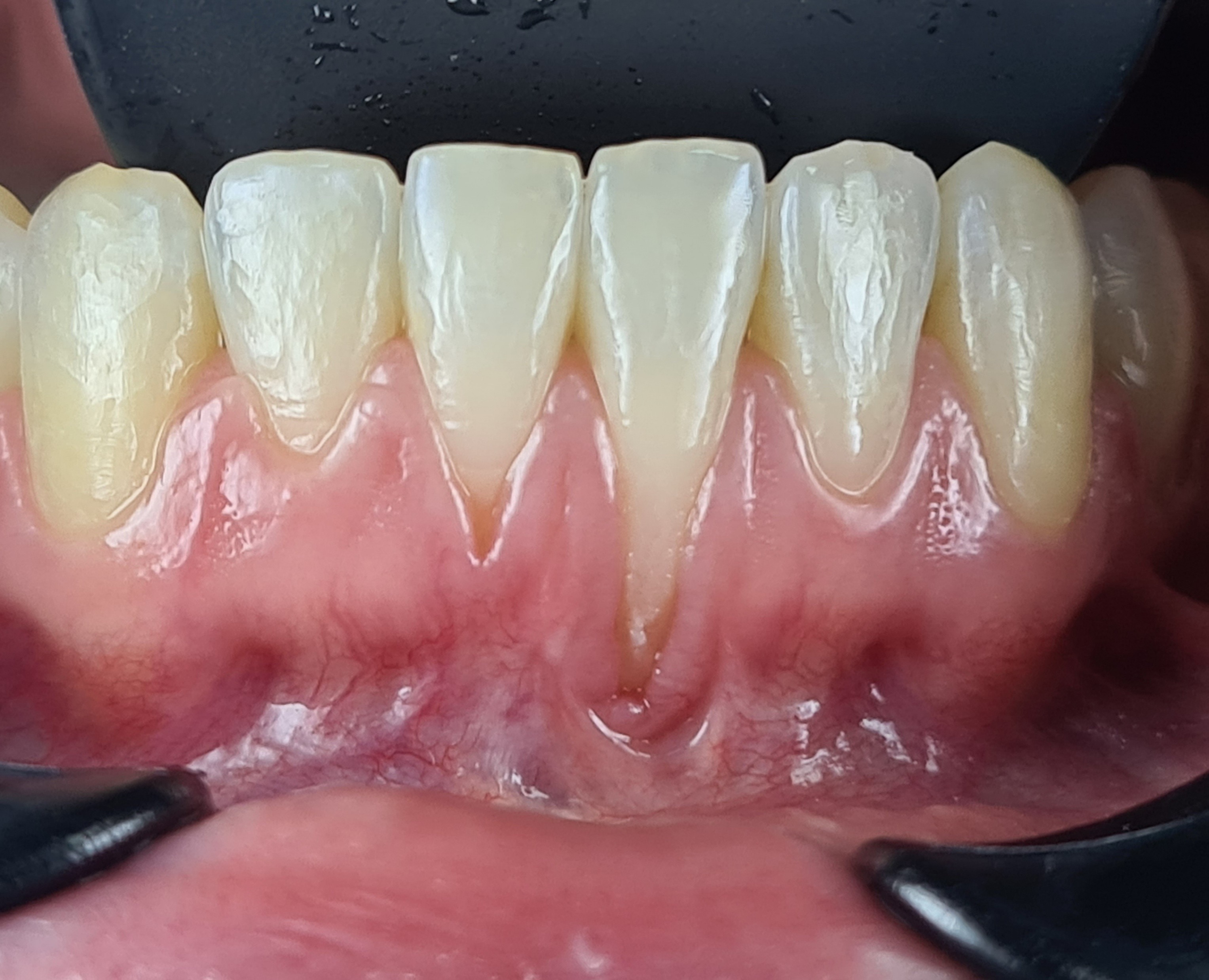 Before gum rejuvenation treatment.