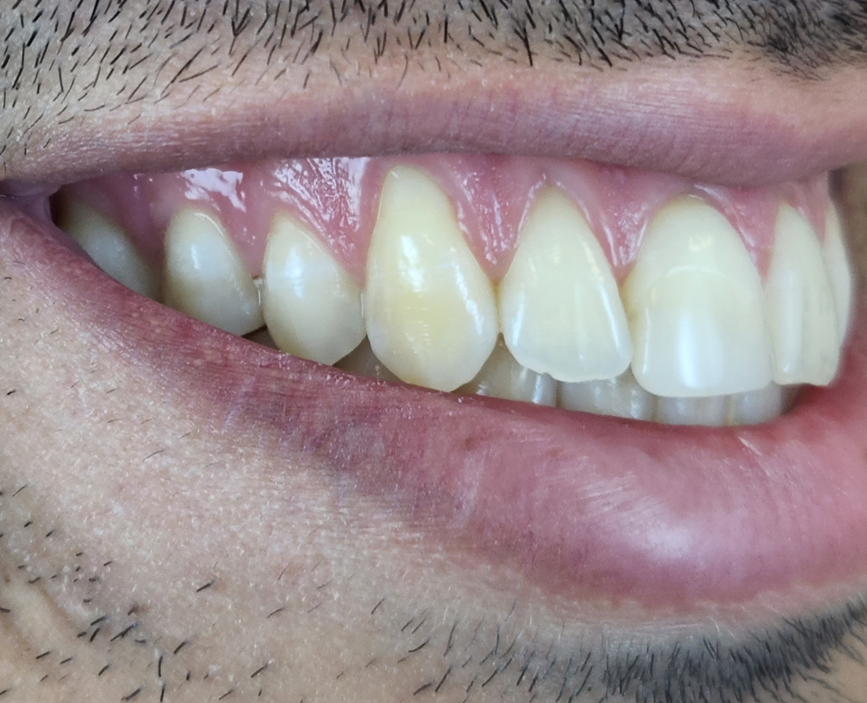 Before anterior gum rejuvenation treatment.