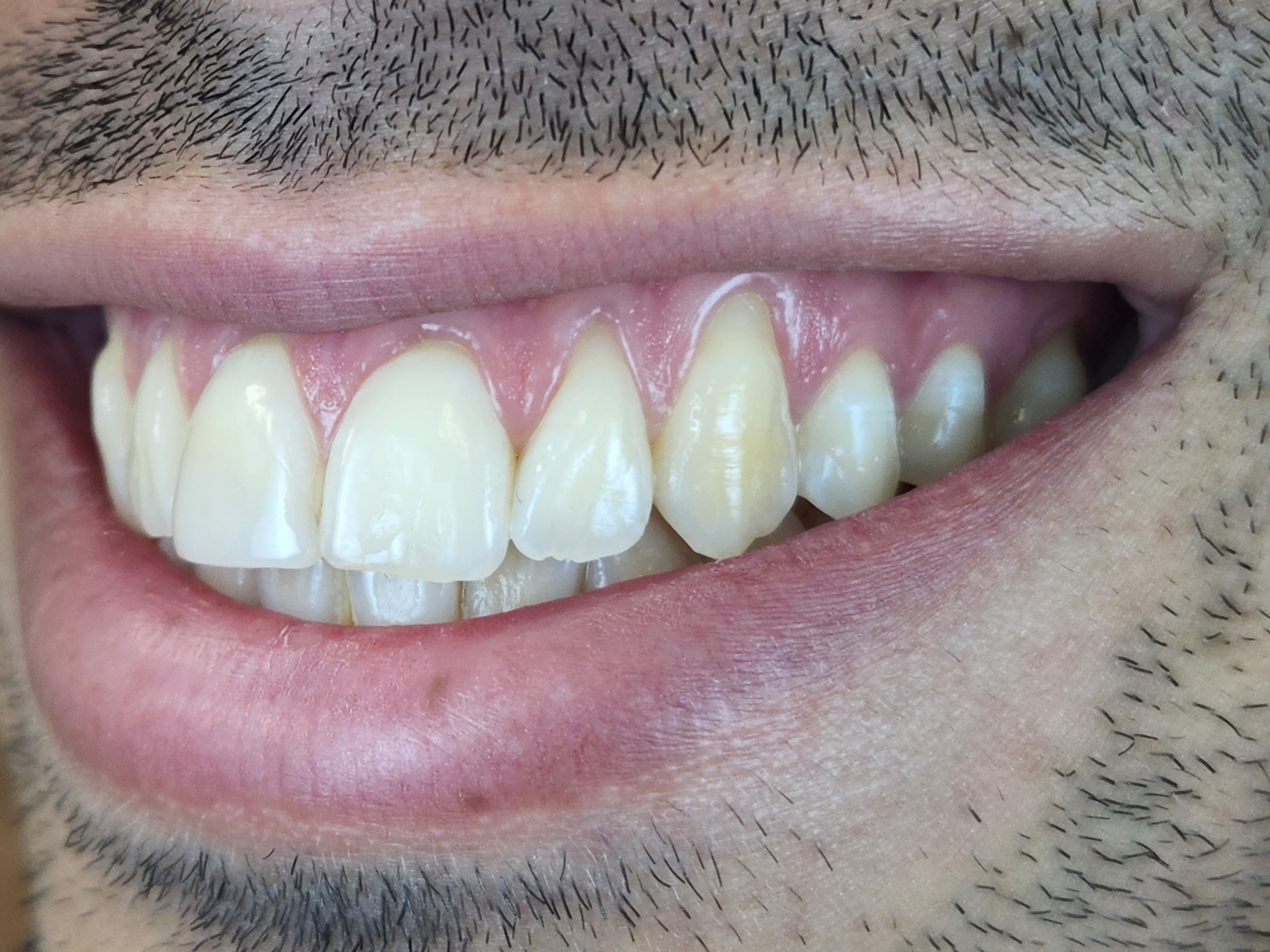 Before anterior recession coverage treatment.
