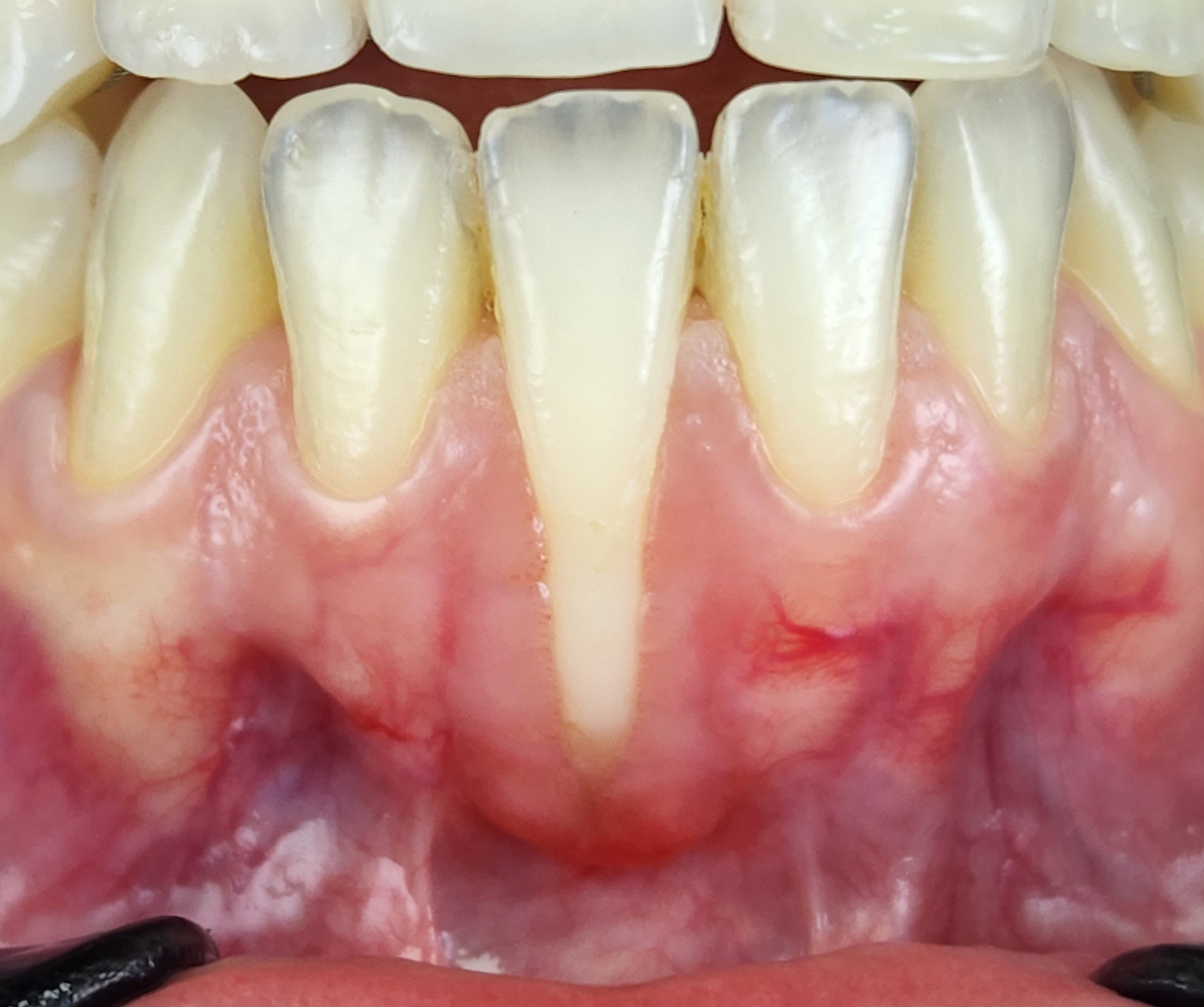 Before gum rejuvenation treatment.