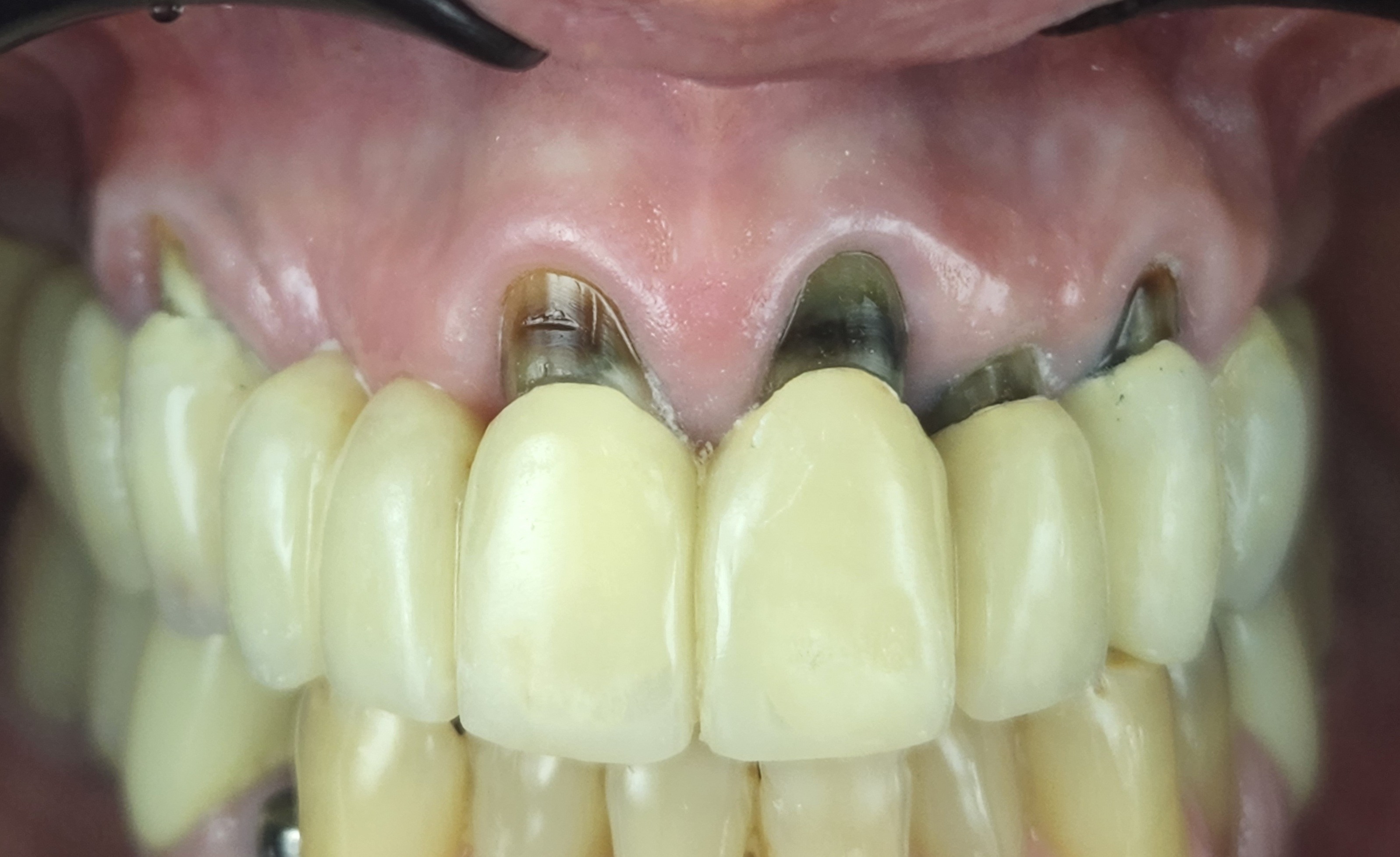 Before gum rejuvenation treatment.