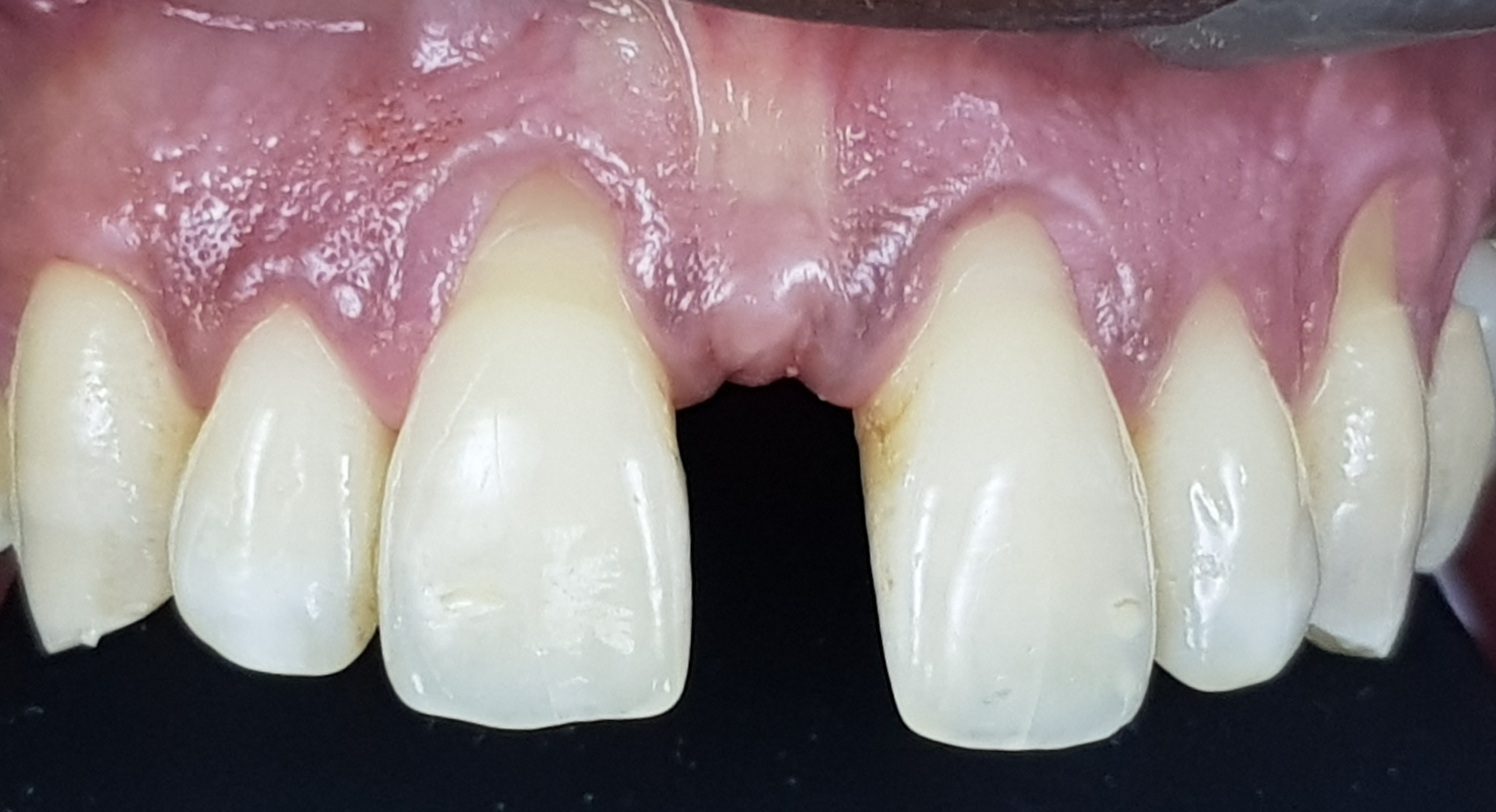 Before anterior gum rejuvenation treatment.