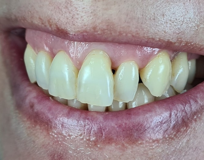Before Miller Class III recession coverage treatment.