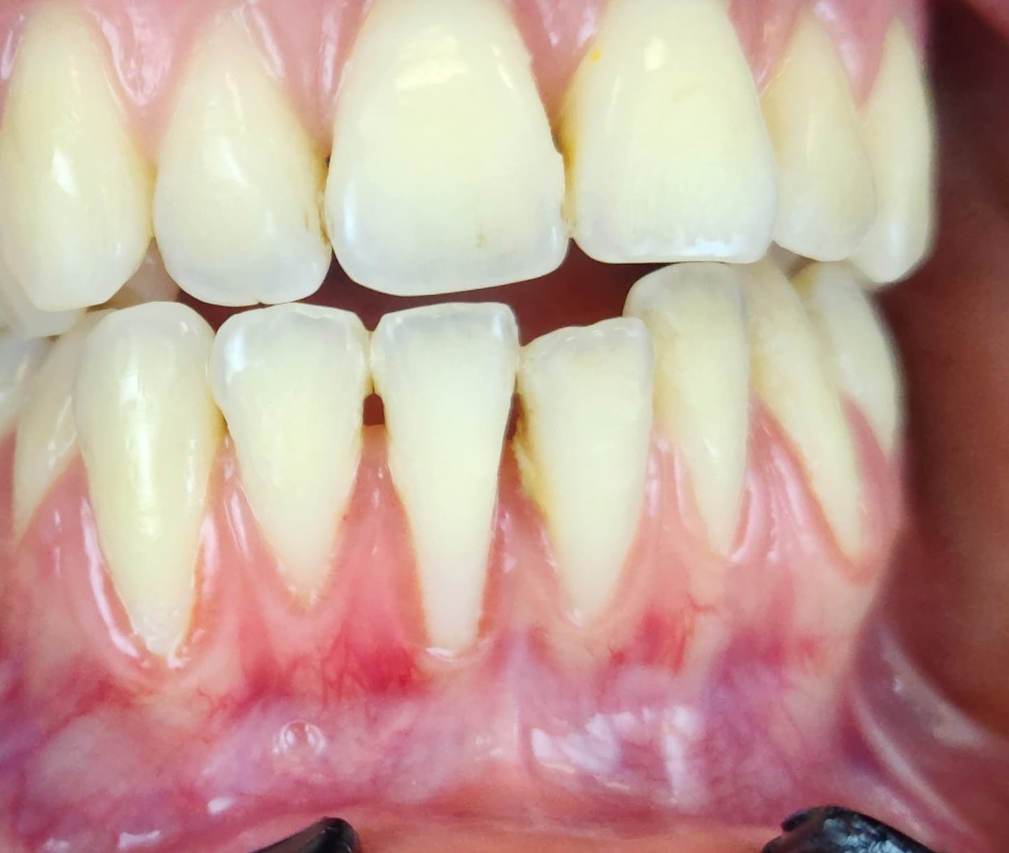 Before lower jaw Miller Class III recession coverage treatment.