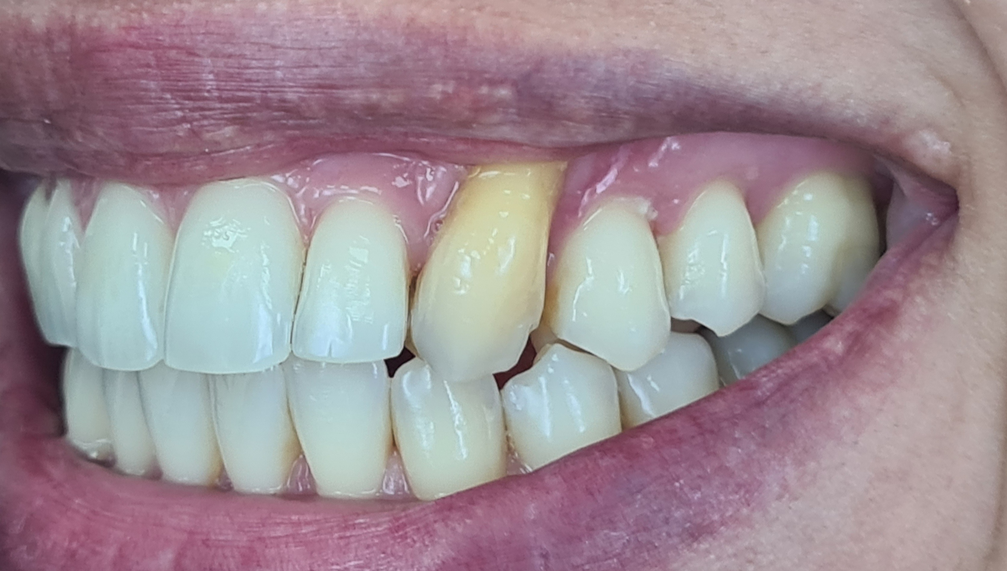 Before anterior gum rejuvenation treatment.