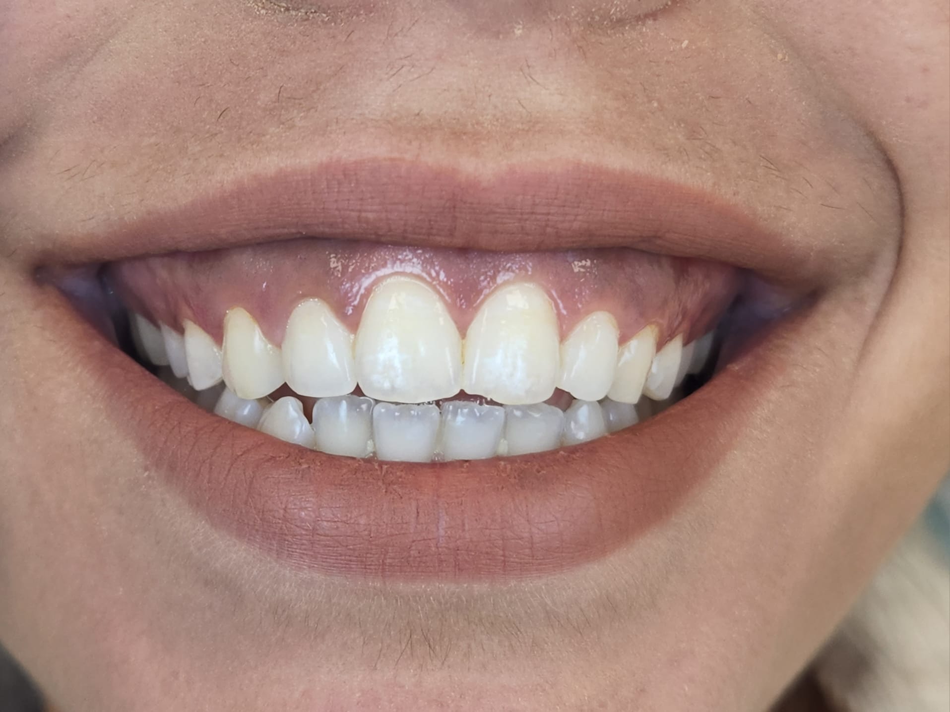 Before aesthetic crown lengthening for gummy smile correction.