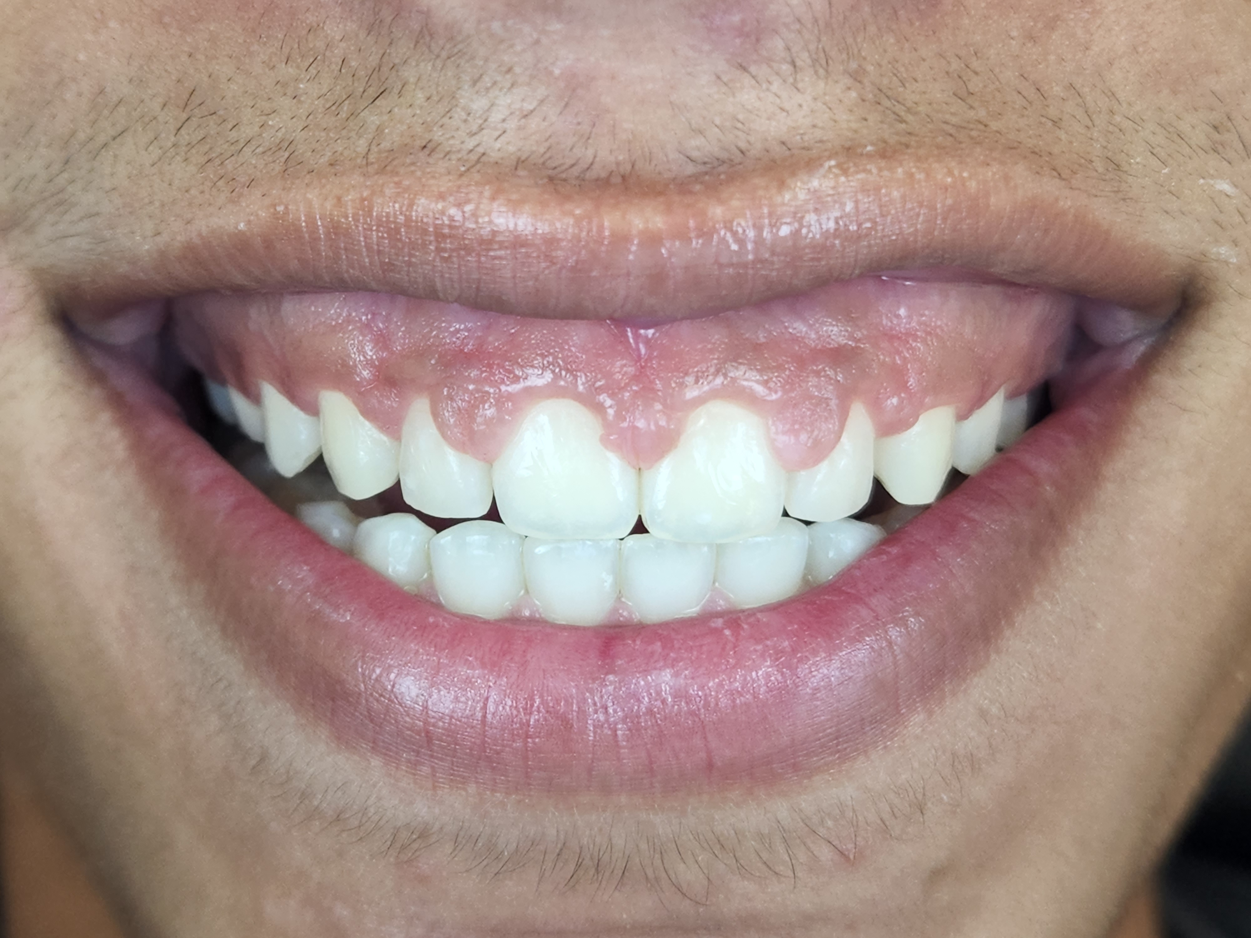 Smile before treatment of gum overgrowth following orthodontic treatment.